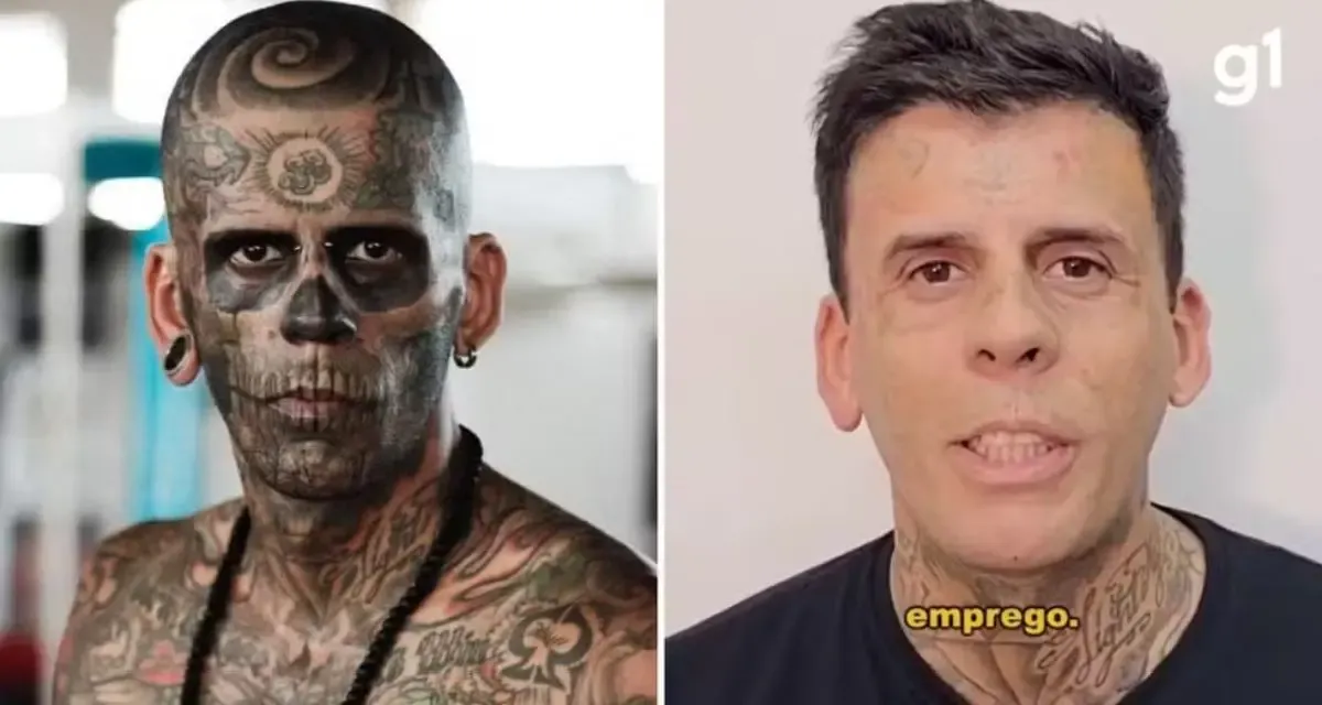 Tratamento com laser transforma rosto do ‘mais tatuado do Brasil’ após conversão evangélica